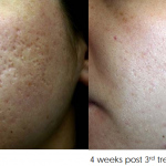 Acne Scar removal treatment melbourne before and after 3 treatments 1 150x150 1