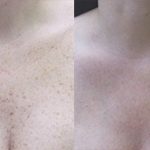 pigmentation before after 150x150 1